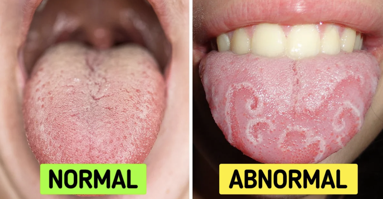 What is White Tongue and How to treat it?