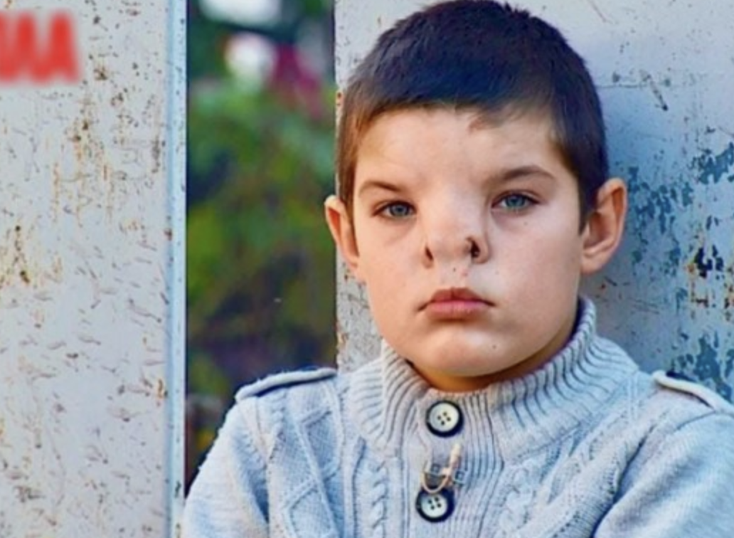 A Boy Born With a Rare Nose Condition Underwent Surgery: What Does He Look Like Now?