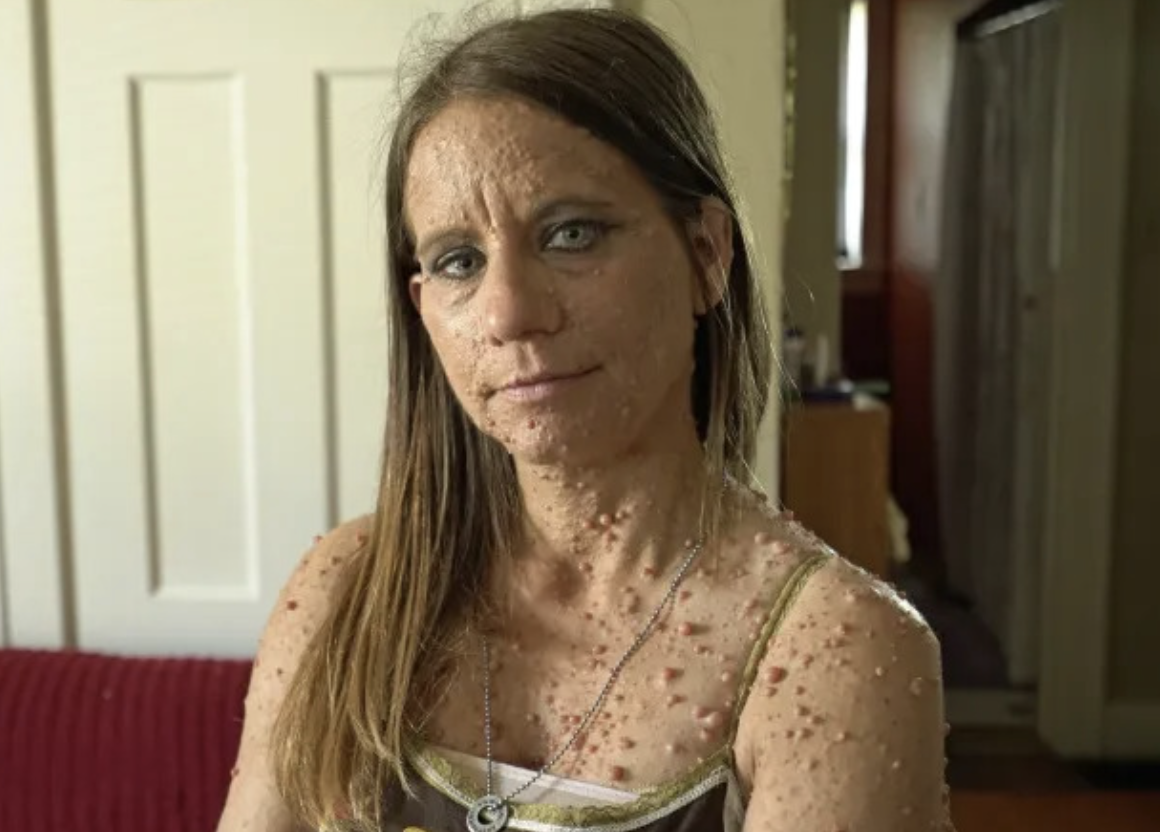 Mum cruelly branded a ‘toad’ due to thousands of tumors covering her body reveals dramatic transformation after undergoing surgery