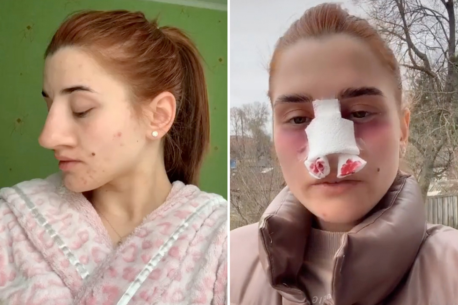 A woman posts before and after photos of her nose operation, and people can’t believe the transformation…