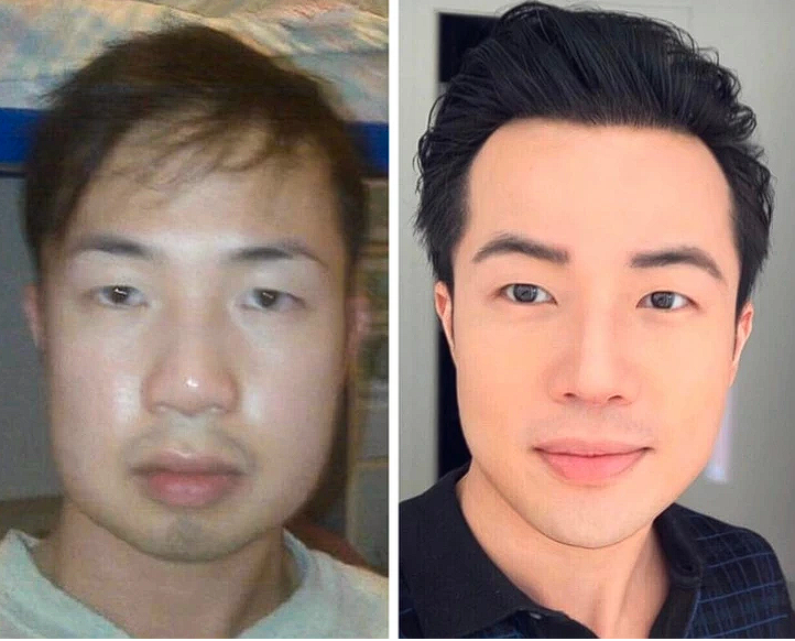 15 People Who Opted for Plastic Surgery and Hit the Jackpot