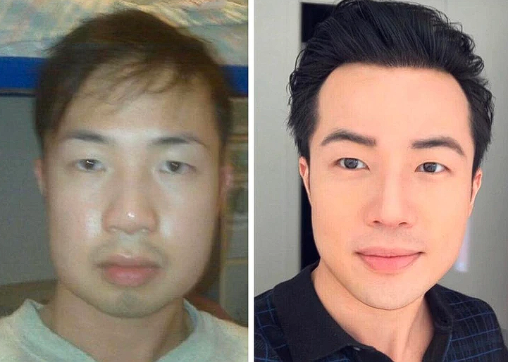 A Man Leaves People Speechless with Remarkable Results from 10 Years of Plastic Surgery