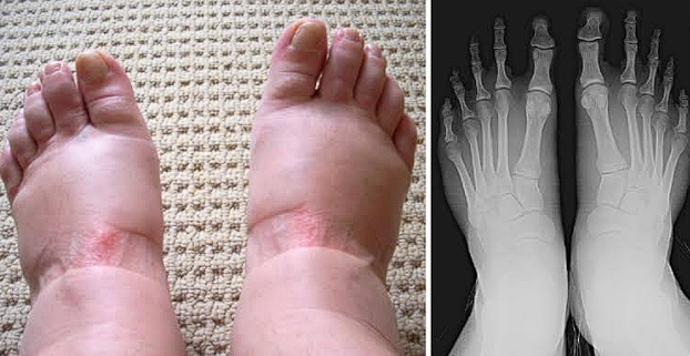 There are nine scary warning symptoms of swollen feet that you should never overlook