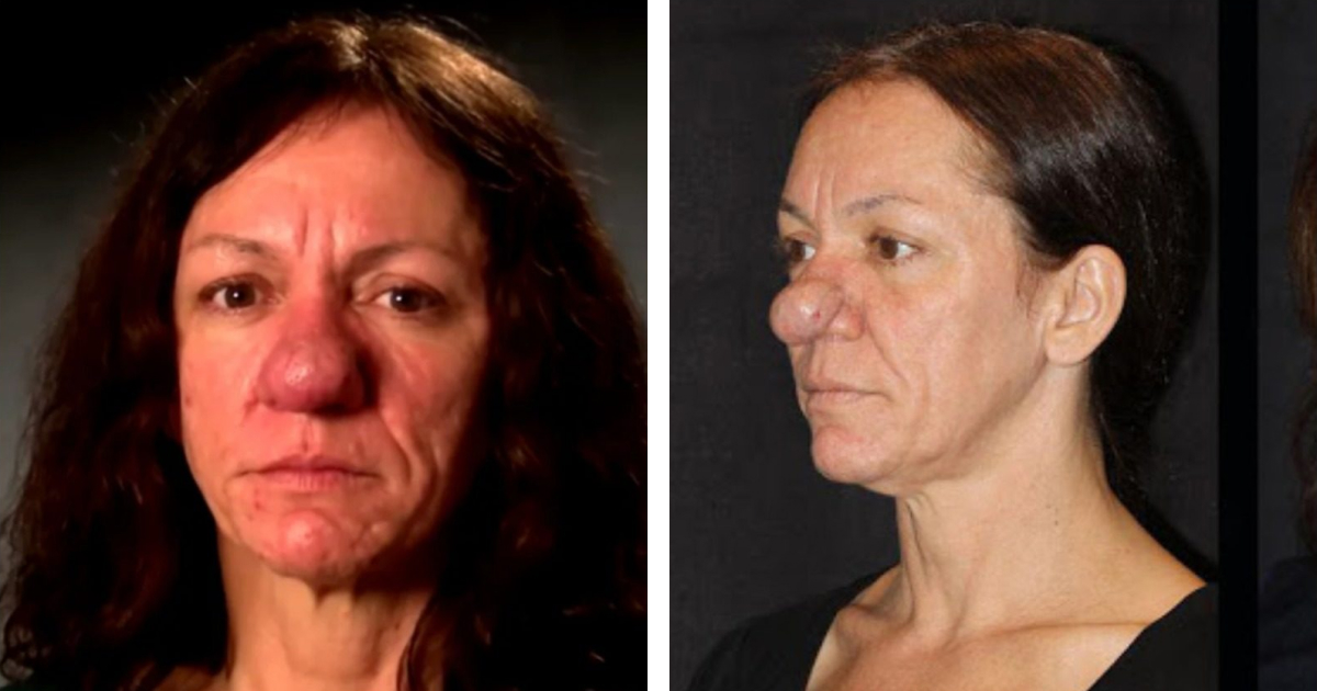 “She Has Become a Real Beauty”: A Woman Born With a Large Nose Due To a Rare Disease Decided To Have Plastic Surgery!