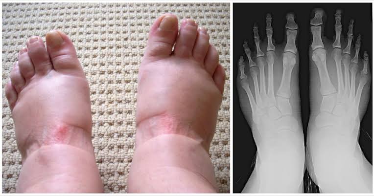 There are nine scary warning symptoms of swollen feet that you should never overlook - SQW