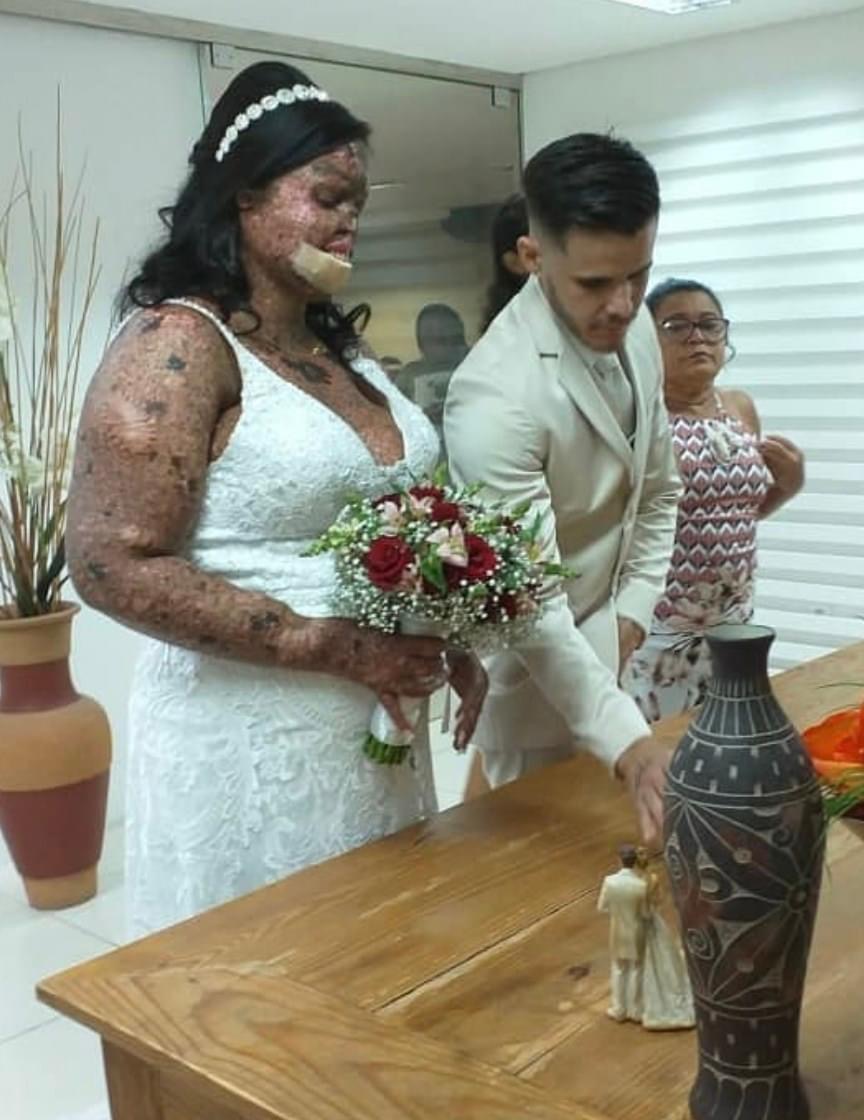 She was bullied by people who didn't understand her condition - they called her rude names & said such as "monster” & ”zombie”.   But her husband has the perfect response to haters - Okoat